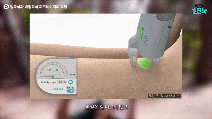 춘천제모 젠틀맥스 장비를 봤다면 부위별 반응도 같이 따져봐야 합니다